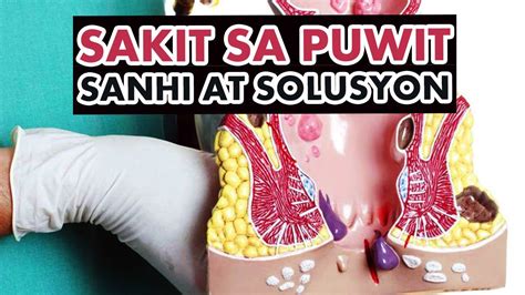 Hemorrhoids or Almoranas: Sakit sa Puwit Sanhi at .